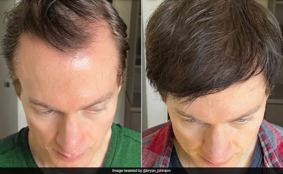 The key to his transformation has been the strategic use of vitamins and nutrients, particularly protein and Omega-3 fatty acids, which have played a crucial role in restoring his hair.